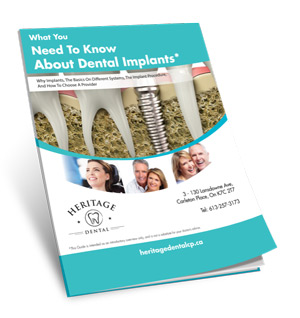 What you need to know about dental implants