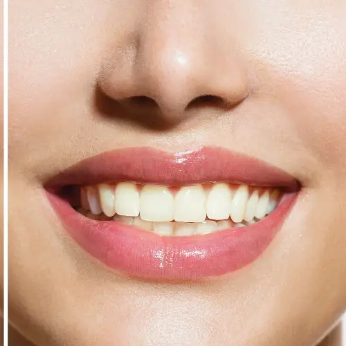 Close-up of a smiling mouth showing a visible contrast in tooth color before and after teeth whitening treatment, with brightened front teeth
